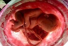 A Magyar Orvosi Kamara is támogatja az új abortuszrendeletet