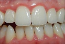 Fogínygyulladás: Okok, tünetek és természetes gyógymódok