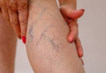 Visszérbetegségek megelőzése és gyógyítása